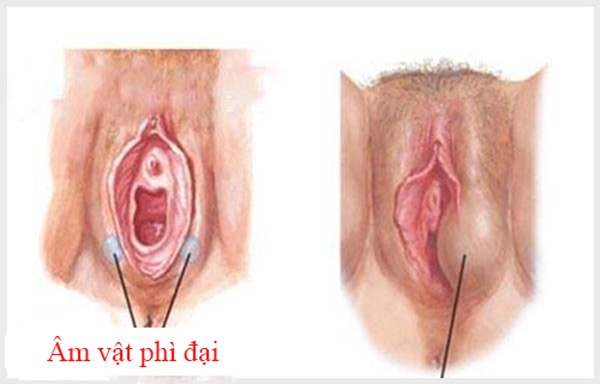 môi bé phì đại