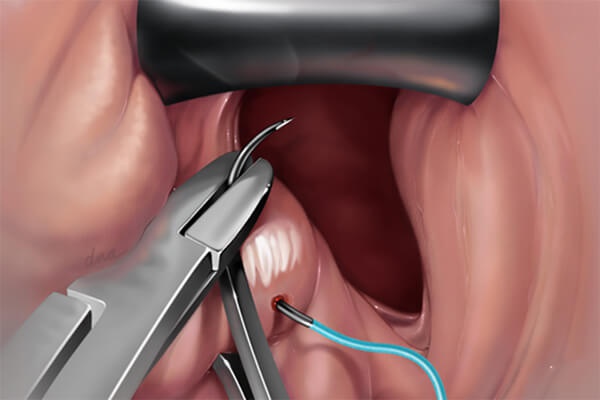 cắt môi bé có để lại sẹo không