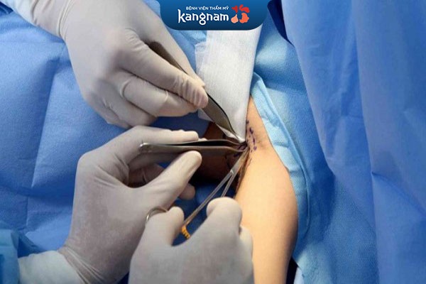 quy trình cắt tuyến mồ hôi nách