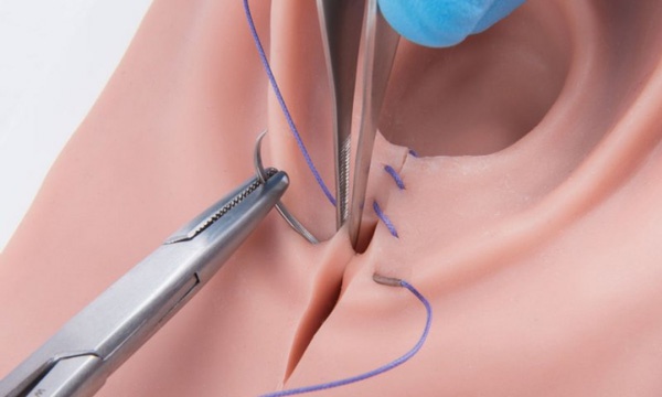 thời điểm khâu tầng sinh môn