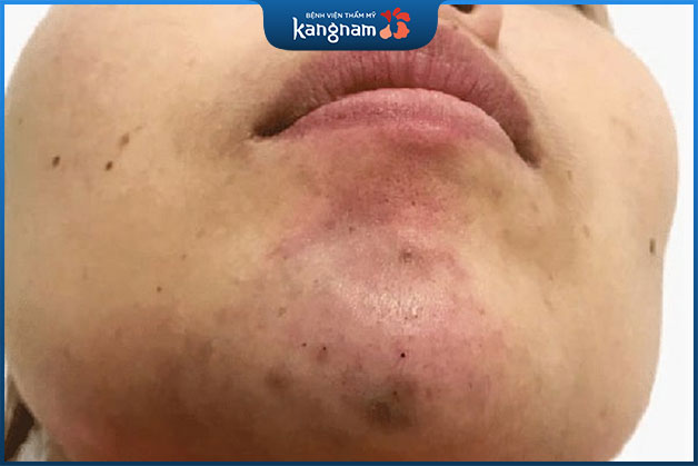 Tiêm filler cằm không tan