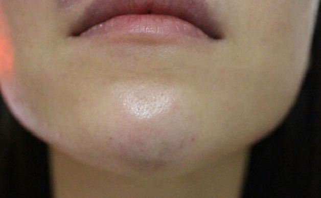 Tiêm filler cằm bị sưng có gây nguy hiểm hay không?