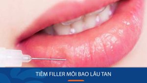 Bảng thời gian tan Filler môi theo từng loại và cách giữ lâu