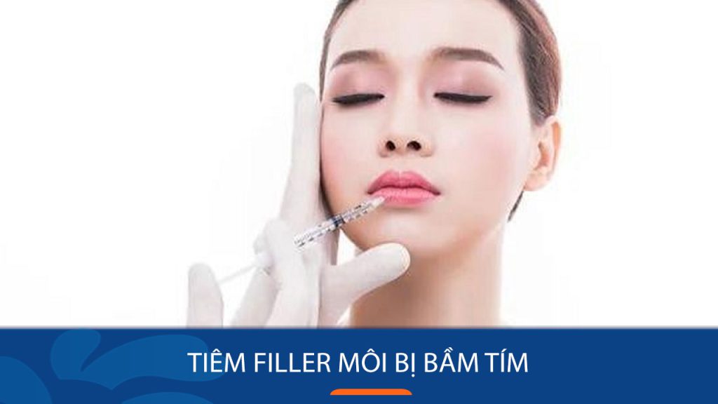 Tiêm Filler Môi Bị Bầm Tím: Bí quyết giảm bầm tím sau khi tiêm filler môi