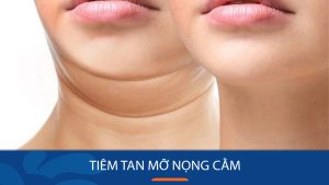 Tiêm tan mỡ nọng cằm là gì? cần lưu ý điều gì