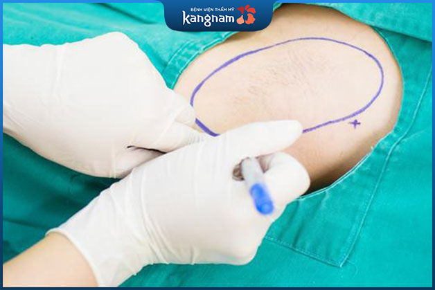 Đây là tiểu phẫu ít xâm lấn nên vô cùng an toàn