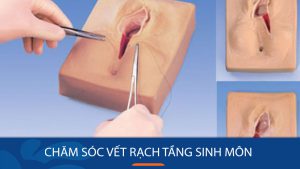 Chăm Sóc Vết Rạch Tầng Sinh Môn Sau Sinh: Giải Pháp Cho Khó Đại Tiện Và Hồi Phục Nhanh