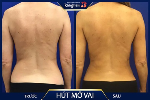 hút mỡ vai