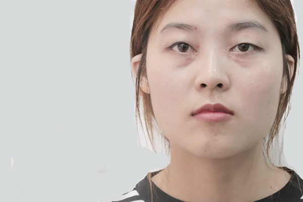 Mắt không cân xứng