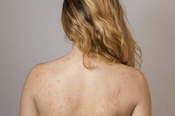 Mụn thịt mọc ở lưng