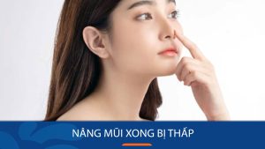 Nâng mũi xong bị thấp: Nguyên nhân, khi nào bình thường & cách xử lý
