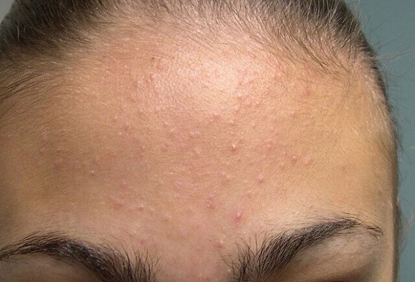 Nguyên nhân gây mụn cám ở trán do da dầu 