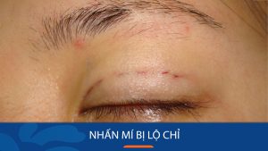 Nhấn mí bị lộ chỉ: Nguyên nhân, mức độ nguy hiểm & cách xử lý đúng