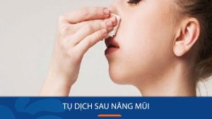 Tụ dịch sau nâng mũi: Nguyên nhân, dấu hiệu và 4 cách xử lý an toàn từ chuyên gia Kangnam