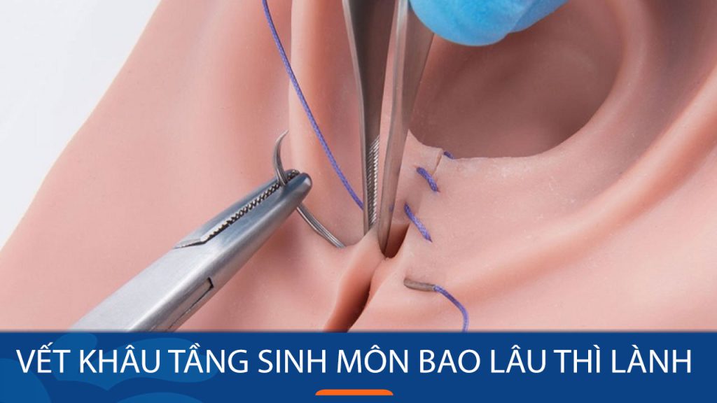 Vết khâu tầng sinh môn bao lâu thì lành?