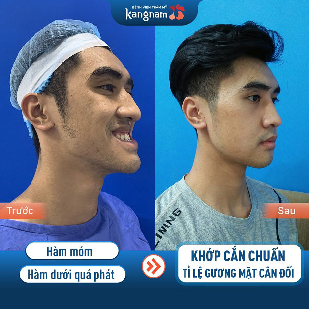 Khách hàng nam sau khi gọt hàm tại Bệnh viện Kangnam