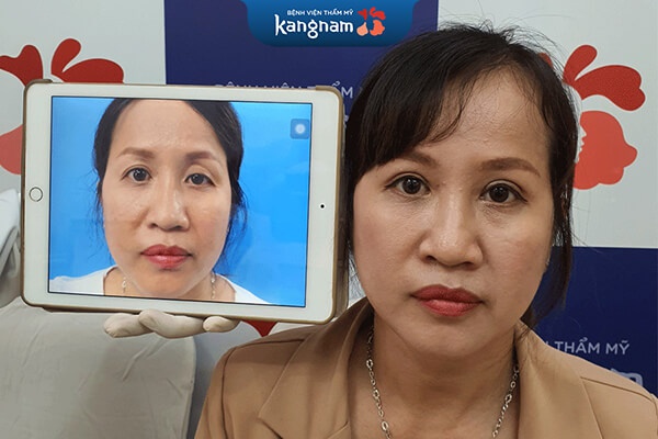 Khách hàng sau khi nhấn mí tại Kangnam