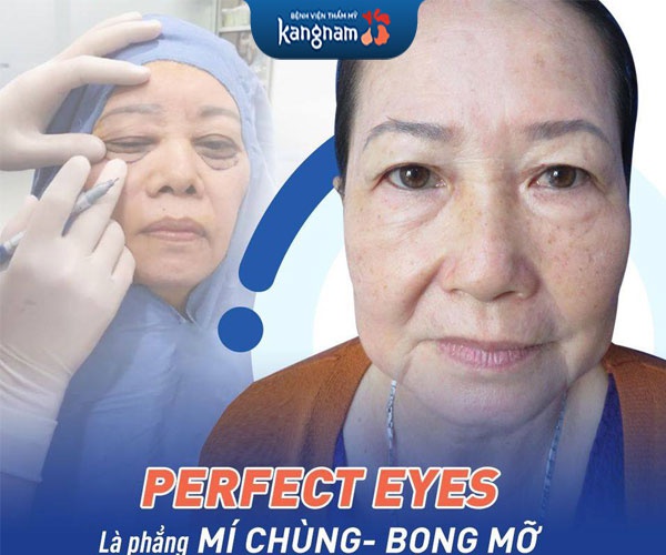 cắt mí Perfect Eyes
