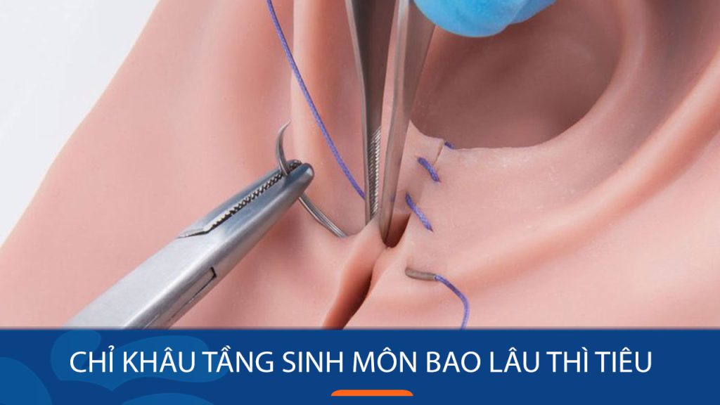 Chỉ Khâu Tầng Sinh Môn Bao Lâu Thì Tiêu? Tìm Hiểu Thời Gian Và Lưu Ý Sau Khi Khâu