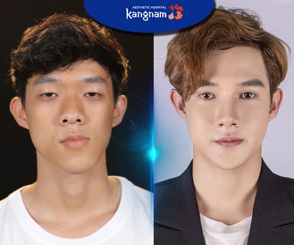 gọt mặt nam bao lâu lành