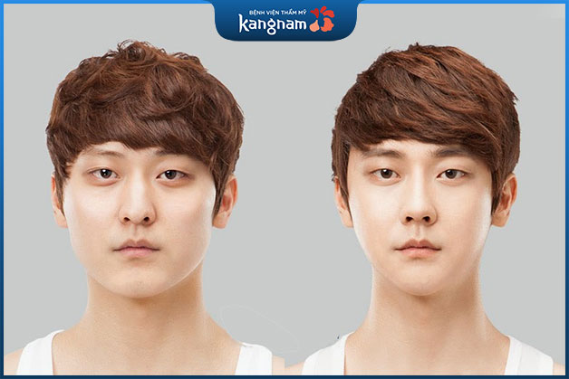 Khách hàng nam sở hữu gương mặt thon gọn hơn sau khi thu gọn góc hàm