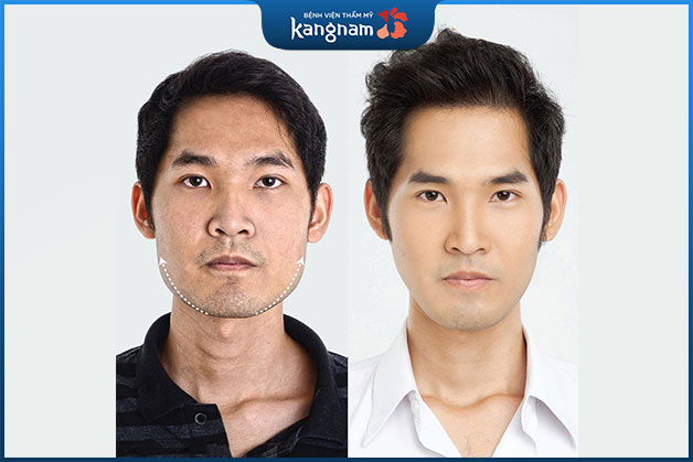 Gương mặt chuẩn Vline sau khi thu gọn tại Kangnam