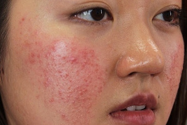 mặt bị sưng sau lăn kim