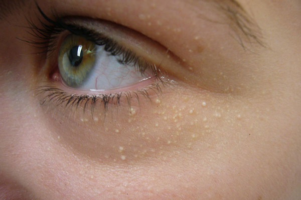 Cẩn thận khi chữa mụn thịt tại nhà