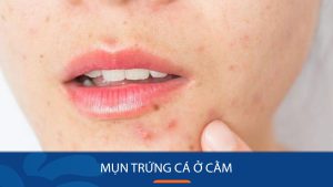 Mụn trứng cá ở cằm:  Bí quyết loại bỏ mụn trứng cá ở cằm dứt điểm