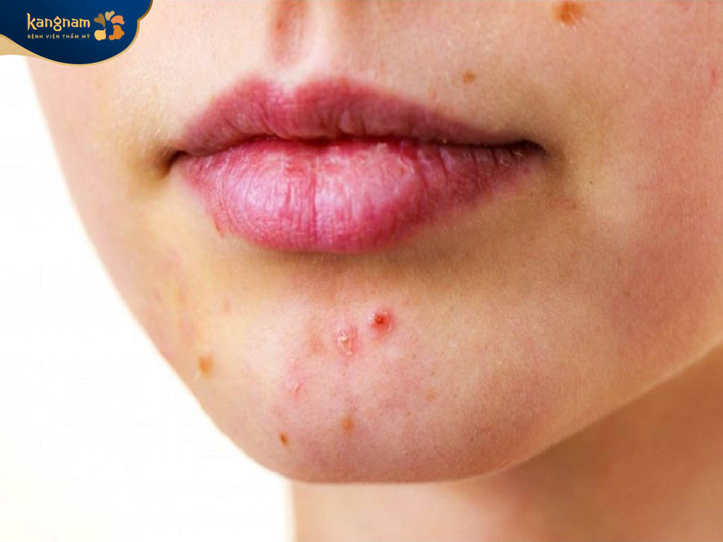 Mụn trứng cá do bệnh phụ khoa