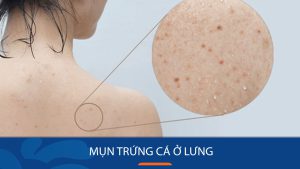 Cách trị mụn trứng cá ở lưng hiệu quả: Giải pháp cho làn da lưng mịn màng không tì vết