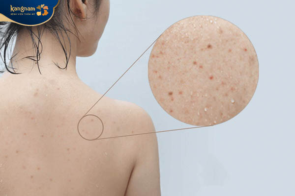 Sau khi vận động tế bào chết, vi khuẩn thường tích tụ nhiều trên vùng lưng