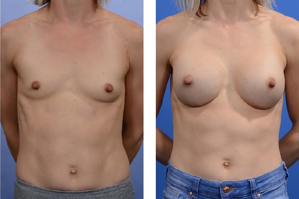 người chuyển giới nâng ngực