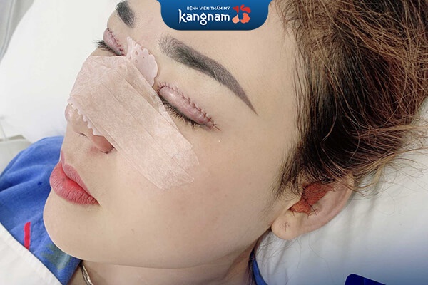 Nhấn mí bao lâu hết bầm tím mắt