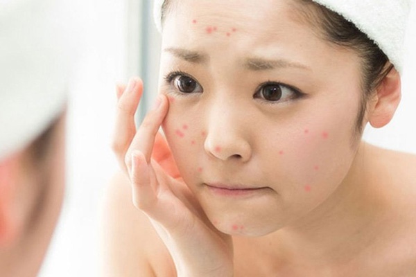 nổi mụn do trang điểm