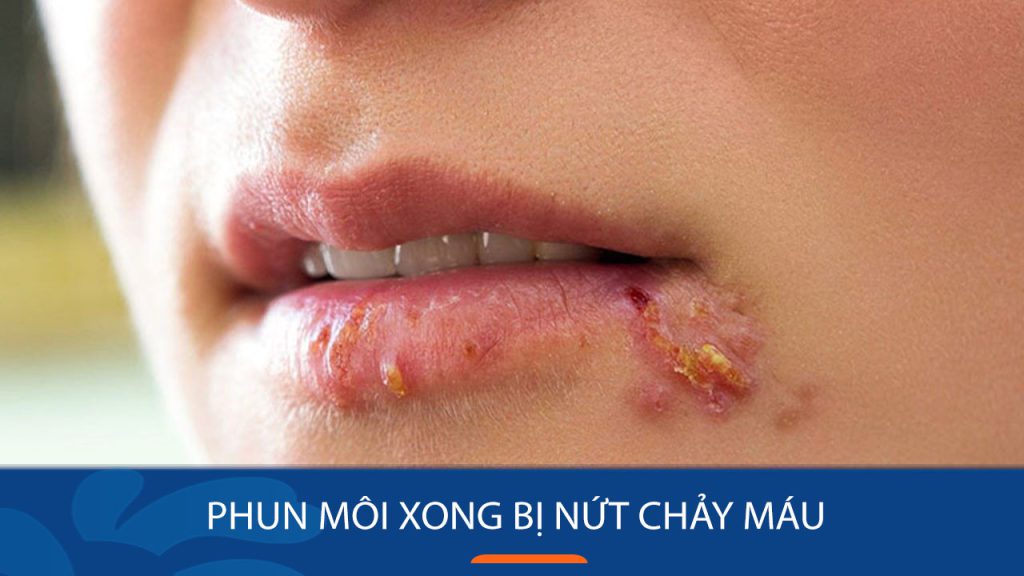 Phun môi bị nứt chảy máu có nguy hiểm không? Giải pháp xử lý nhanh chóng