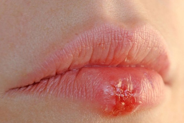 Mặt khác, nếu bác sĩ dùng đến dụng cụ phun chưa được vô trùng sẽ tạo điều kiện cho vi khuẩn tấn công, gây sưng tấy, mất cân bằng độ ẩm ở bề mặt da. Cuối cùng, làm cho da môi bị khô, nứt nẻ và lên không đều.