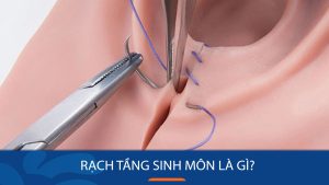 Rạch Tầng Sinh Môn: Khi Nào Cần Thực Hiện & Lưu Ý Sau Khi Sinh