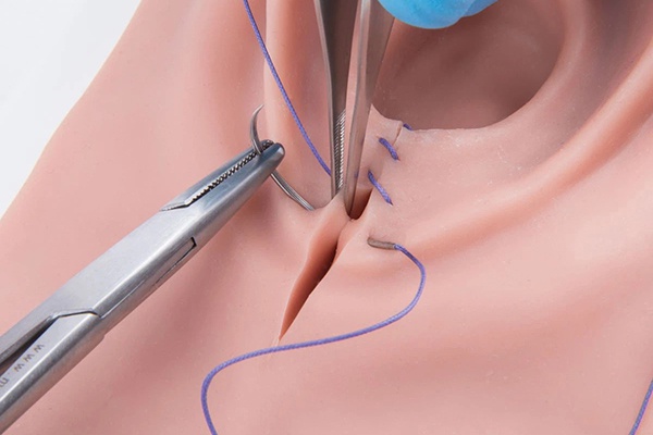 rạch tầng sinh môn thế nào