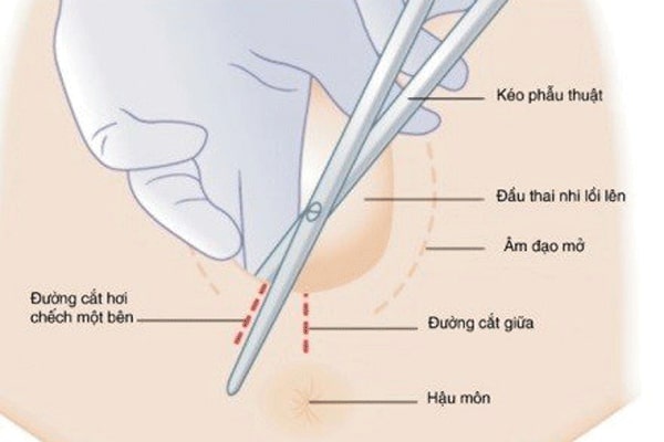 thủ thuật cắt tầng sinh môn