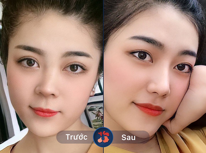 Album ảnh khách hàng nâng mũi