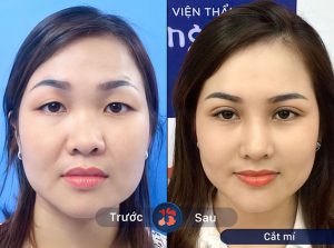 ALBUM KHÁCH HÀNG THẨM MỸ MẮT