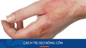 5 Cách Trị Sẹo Bỏng Cồn Hiệu Quả Tại Nhà Hiệu quả tức thì
