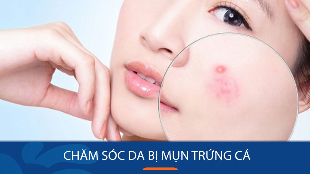Chăm sóc da bị mụn trứng cá – Đánh bay mụn trứng cá chỉ trong 7 ngày