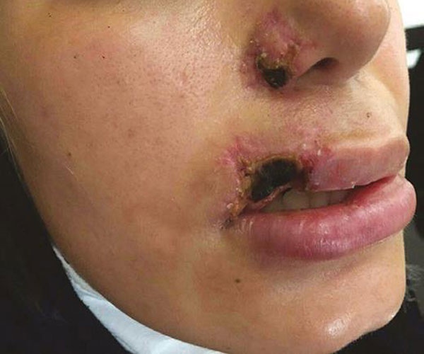 Tiêm môi sai cách là hoại tử da và lưu lại dị tật