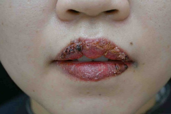 Môi bị nhiễm trùng