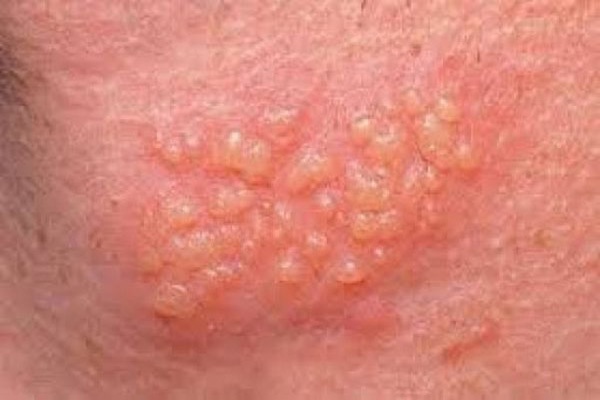 mụn cóc sinh dục