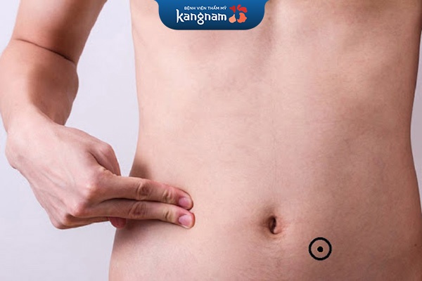 mụn ruồi bên phải rốn