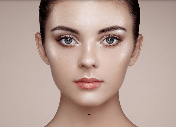 mụn ruồi giữa yết hầu