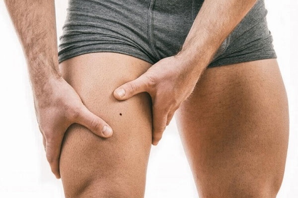 mụn ruồi trước đùi